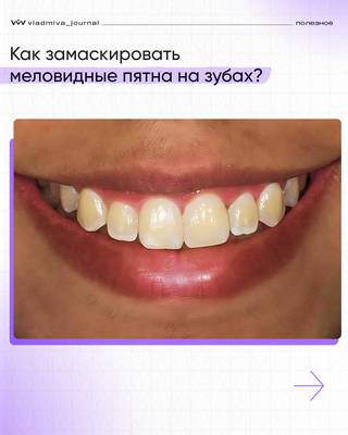 ICON и микроабразия — маскировка белых пятен без сверления.